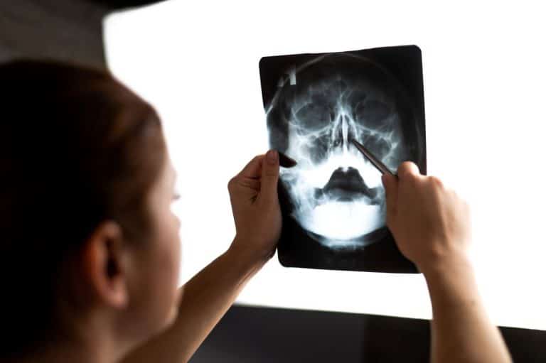 Sinus Surgery Xray Person holding an xray of a human head up to a light board. They are holding the image in their left hand and pointing at the nasal cavity with a long silver instrument in their right hand.